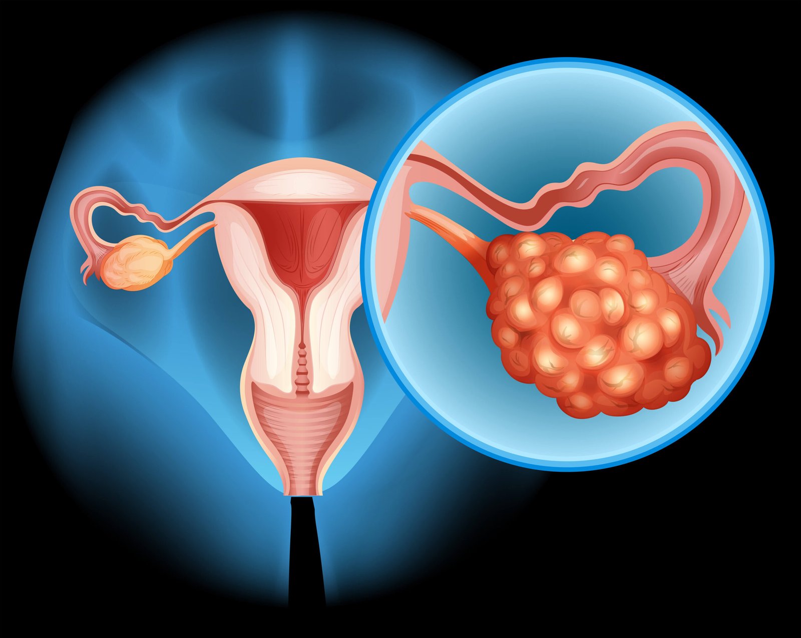 Uterine Fibroids treatment in kalamboli